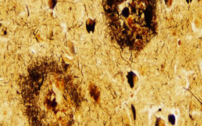 La maladie d’Alzheimer en questions